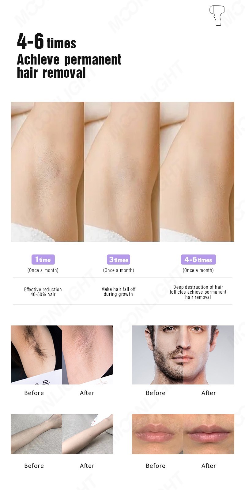 laser hair removal D2 12 laser hair removal D2 12